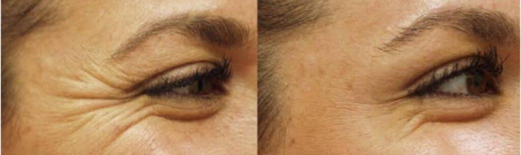 Anti wrinkle Treatment