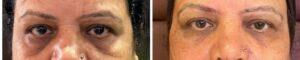 Under Eye Correction With Fillers