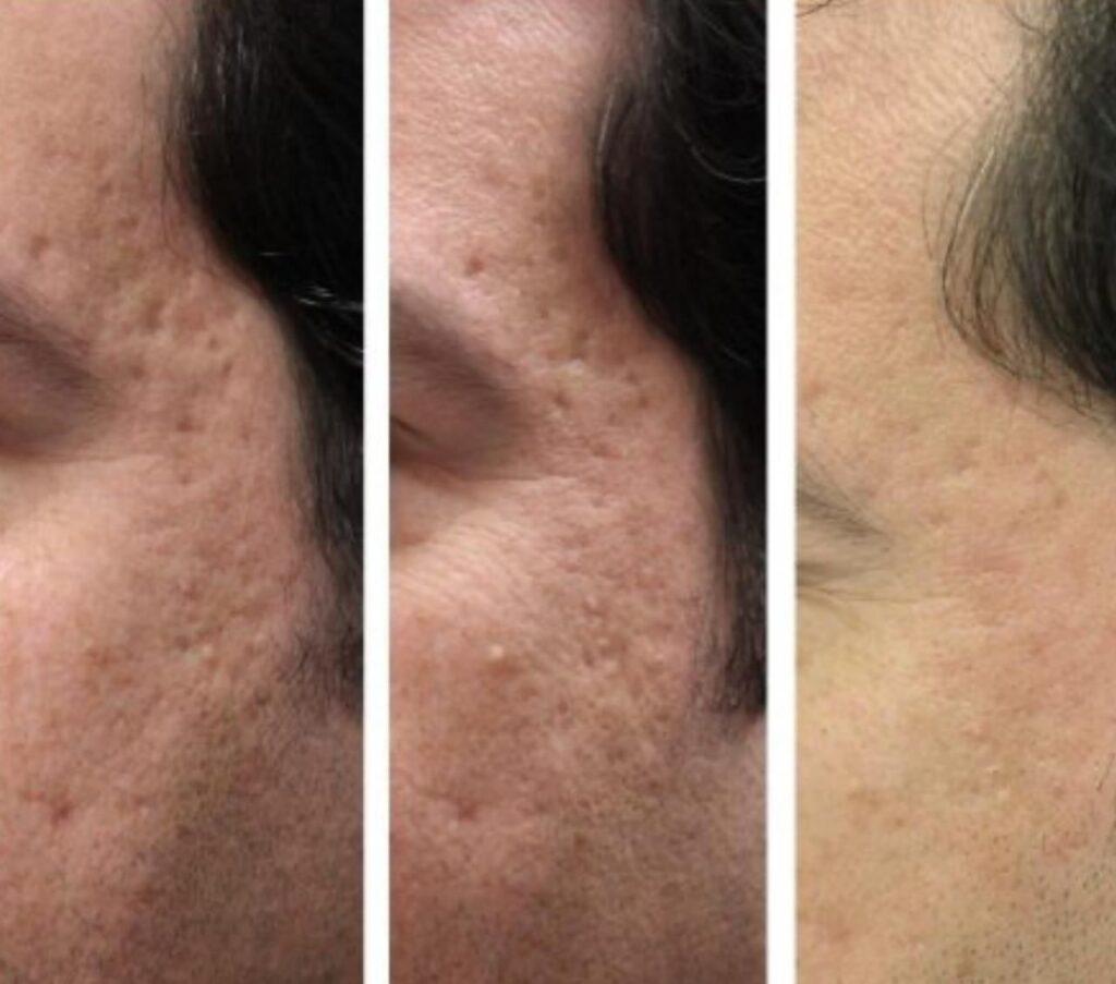 Acne Scar Treatment With Lasers