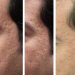 Acne Scar Treatment With Lasers