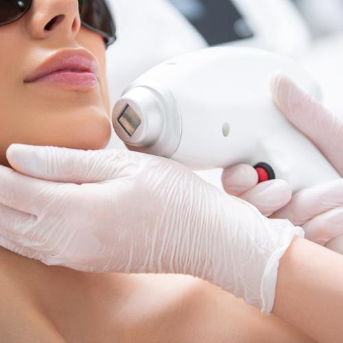 side locks laser hair removal