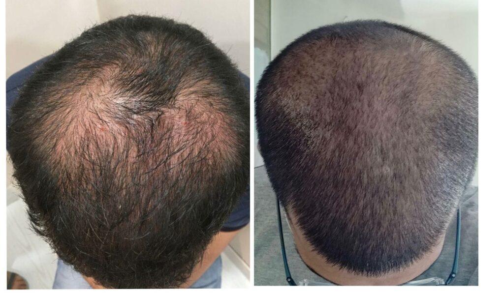 PRP-Treatment for hair hair treatment