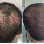 PRP-Treatment for hair hair treatment