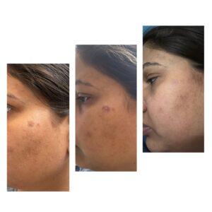 skin resurfacing acne scar treatment pigmentation