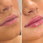 Lip filler