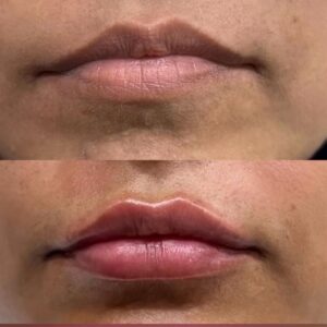 lip enhancement by dermal filler