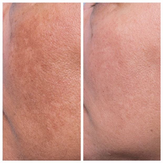 Hyperpigmentation treatment before after