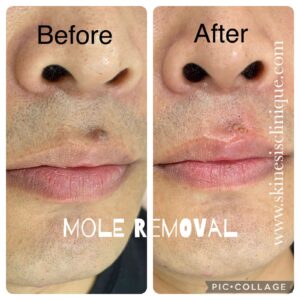 mole-removal-vasant-vihar-delhi