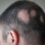 alopecia-areata-hair-loss