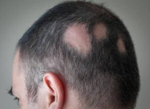 alopecia-areata-hair-loss