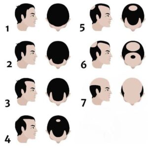 Norwood-scale-hair-loss