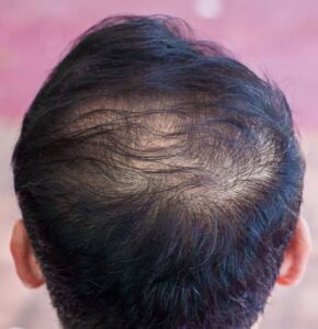 telogen-effluvium-hair-loss