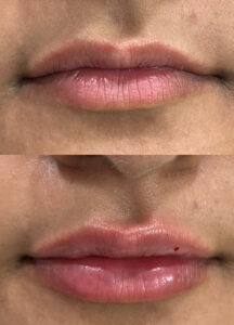 Lip enhancement