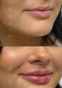 lip-filler