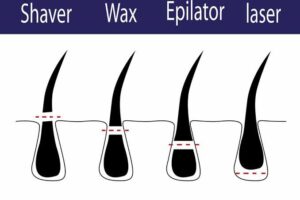 waxing-laser-hair-removal