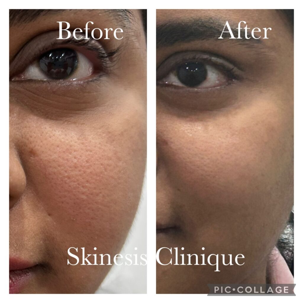 Open pore treatment