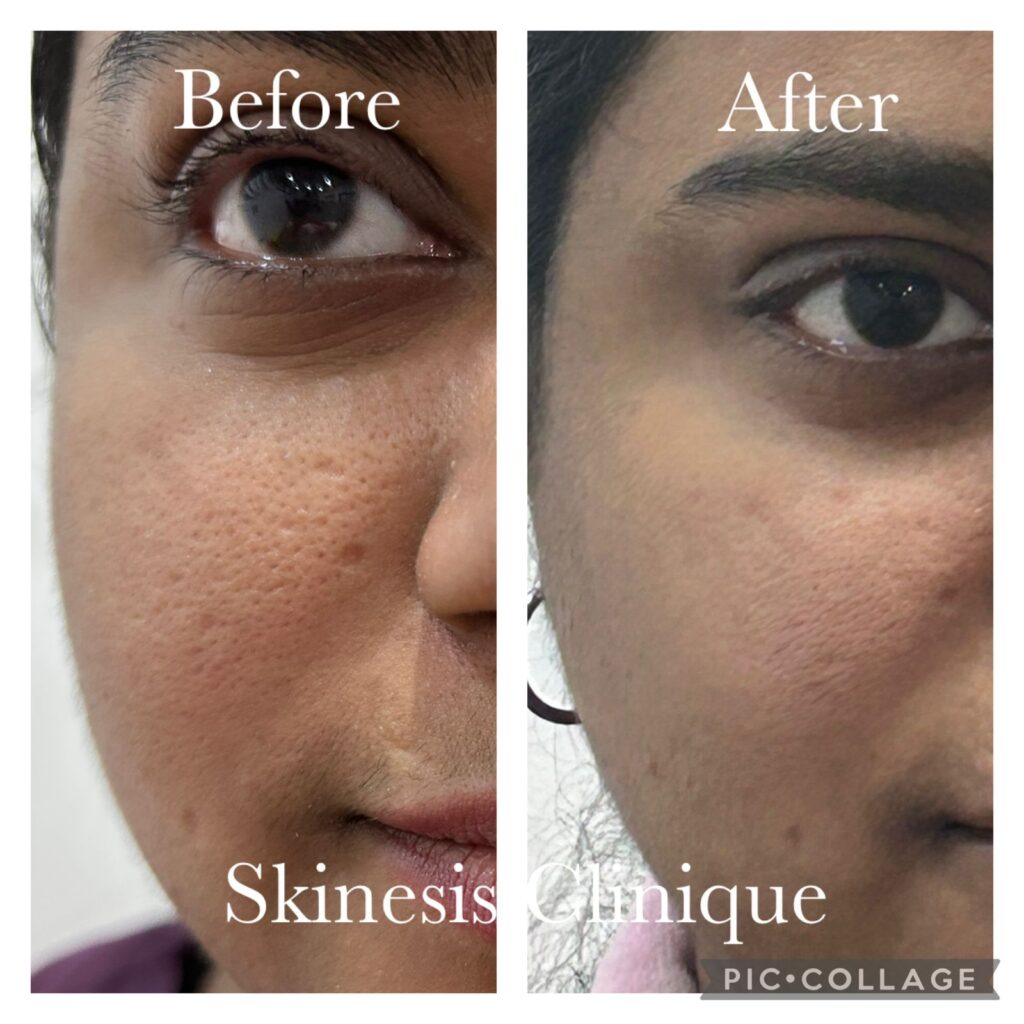 Open pore treatment