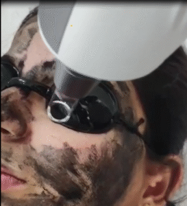 Carbon laser benefits
carbon laser facial cost 