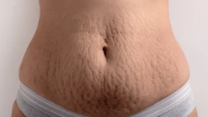 Exosome therapy for stretch marks