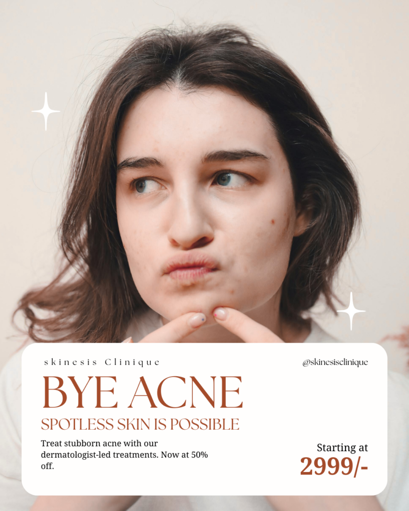 Acne treatment acne scar treatment acne marks treatment pimple treatment offers