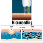 microneedling and prp