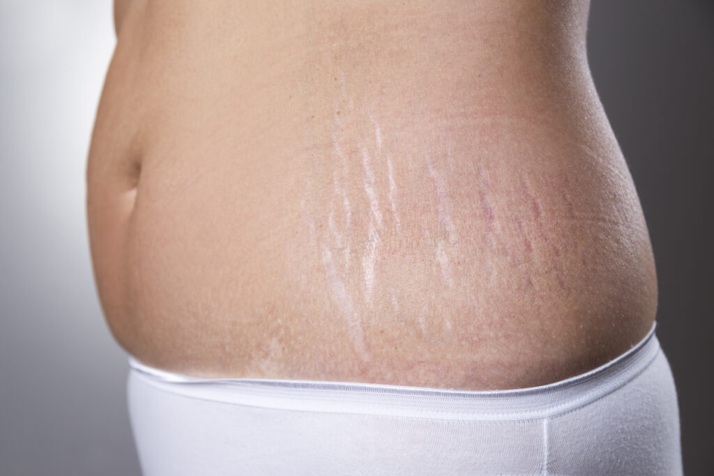 Stretch Marks treatments
