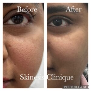 Open pore treatment before after