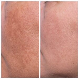 Pigmentation treatment  before after