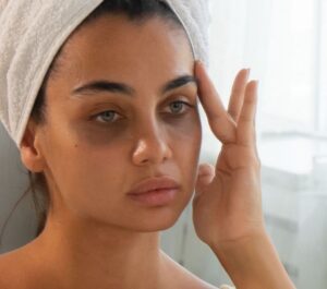 undereye hollowness