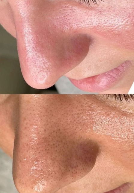 Before and after blackhead removal