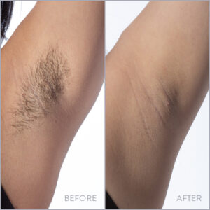 Laser Hair removal / Laser hair reduction under arm and bikini