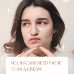 Acne scar treatment delhi