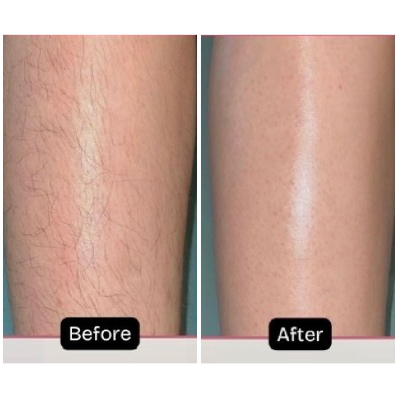 Legs laser hair reduction / removal