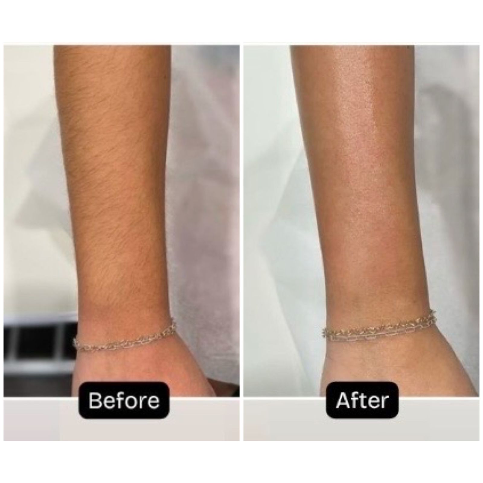 Arm laser hair removal / reduction