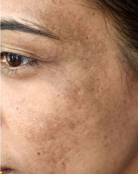 Pigmentation & Tanning