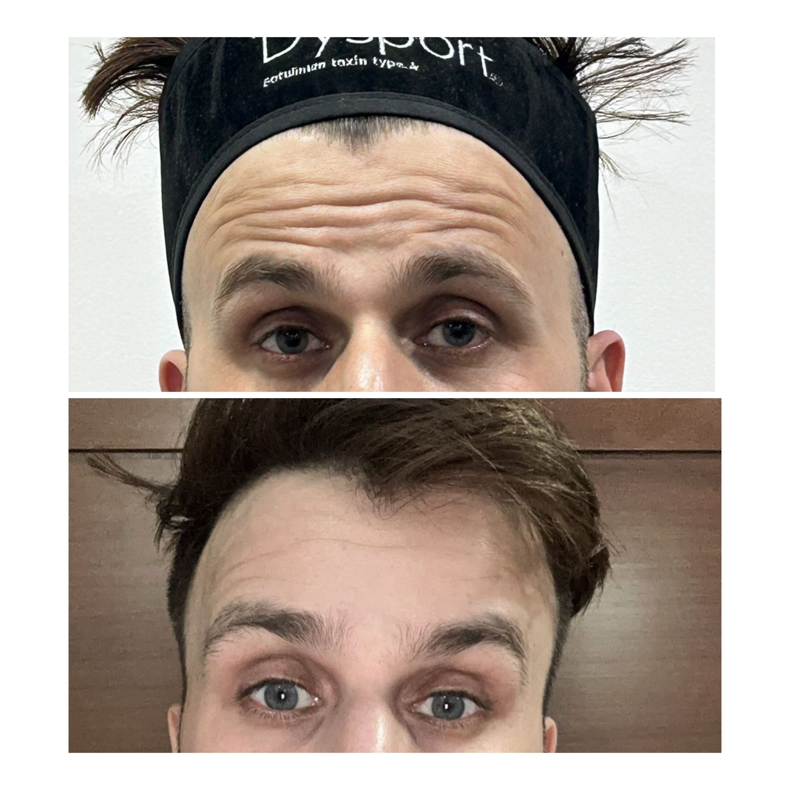 Wrinkle treatment