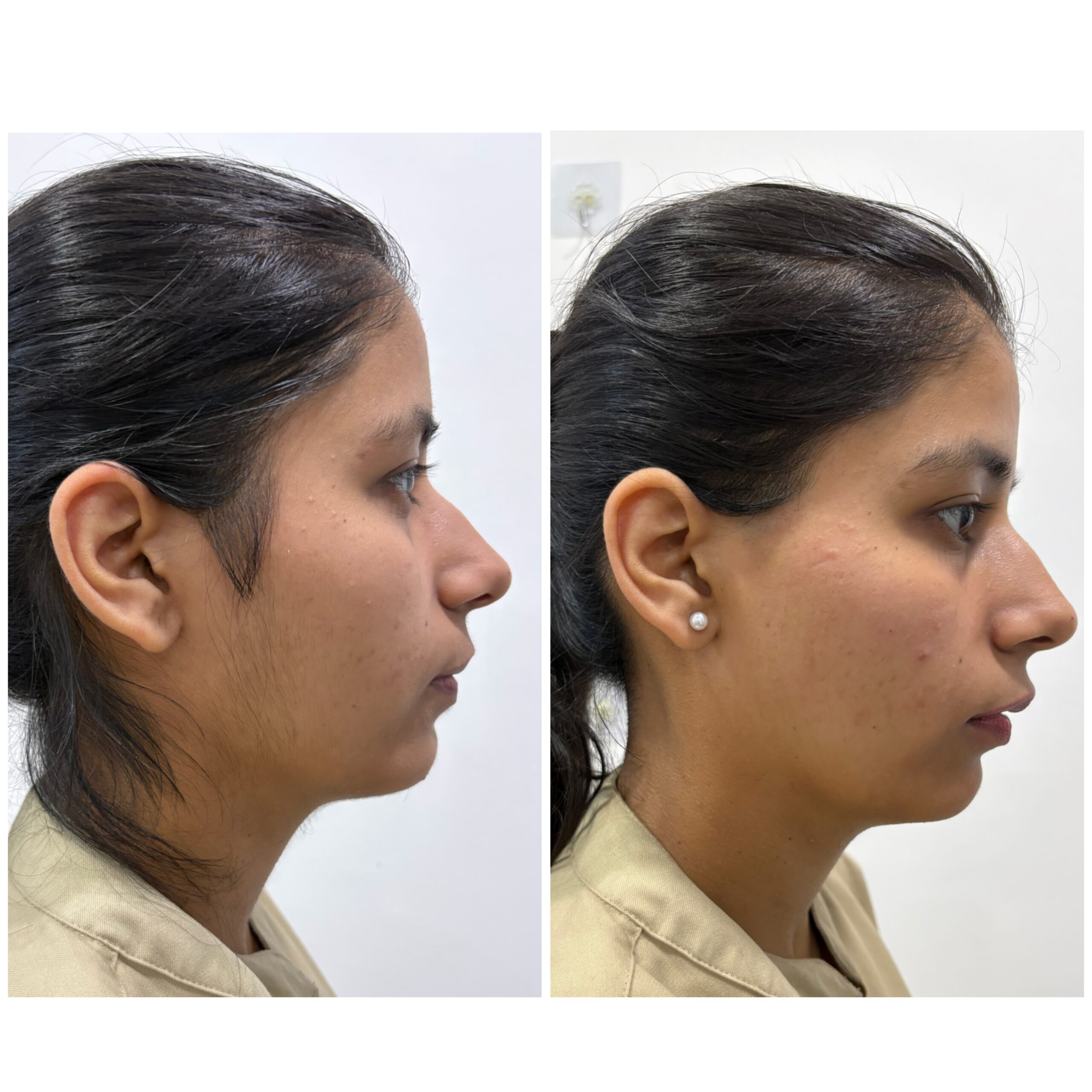 Laser Hair removal