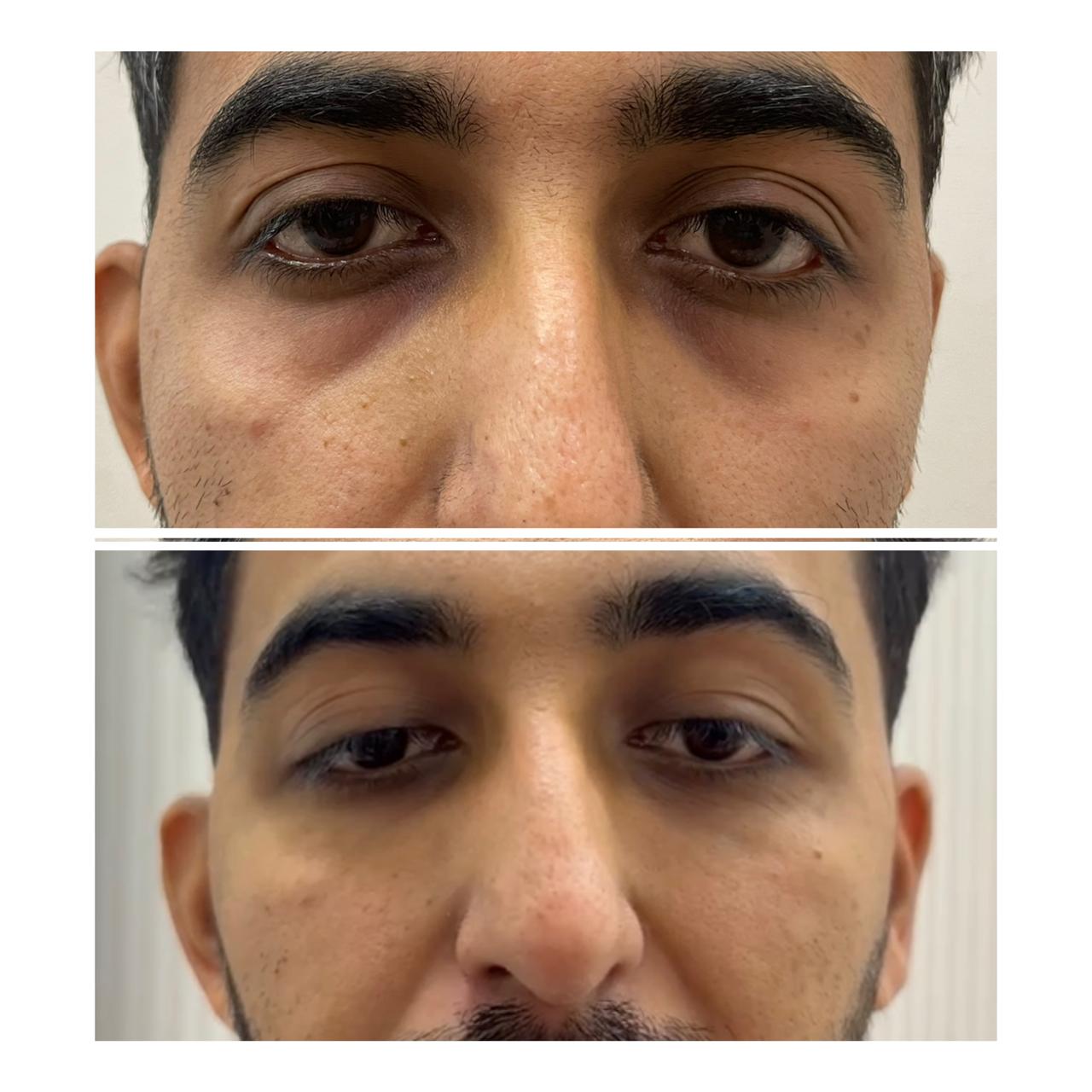 Undereye hollowness dark circles